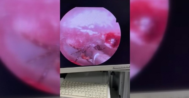 Kulak ağrısıyla hastaneye gitti, kulağından kene çıktı
