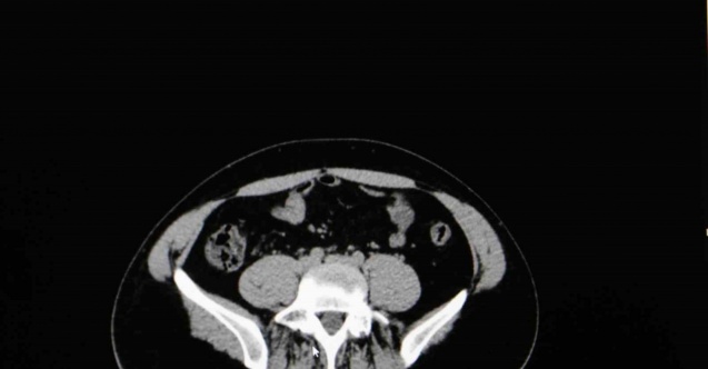 Uzmanından yaz aylarında çok görülen sistit uyarısı