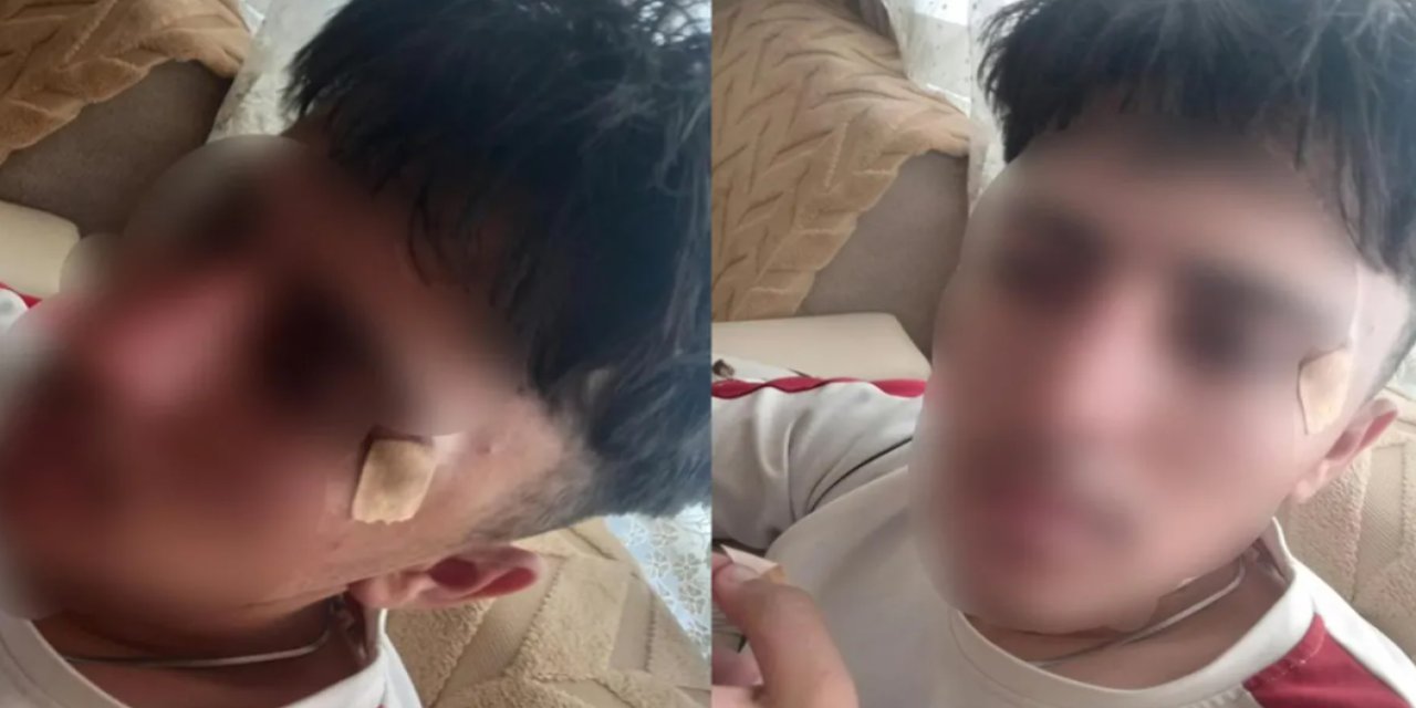 İddiaya Göre Öğrencisinin Burnunu Kıran Öğretmen Hakkında Soruşturma Açıldı!