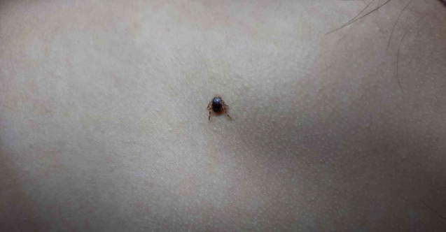 Çocuğun sırtındaki kene hastanede çıkartıldı